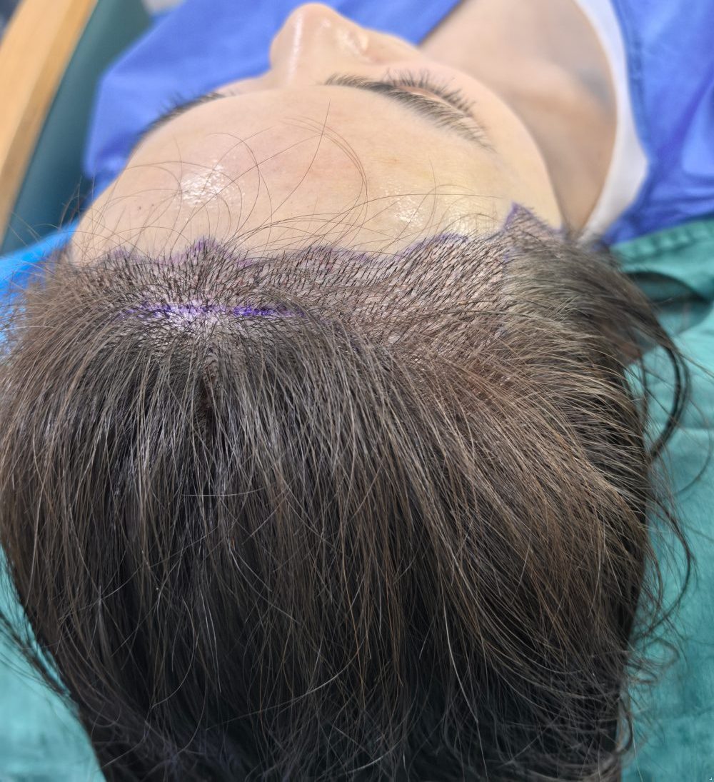 香港植髮邊間好？FUT同FUE分別係咩？毛囊存活率、術後護理一次講清