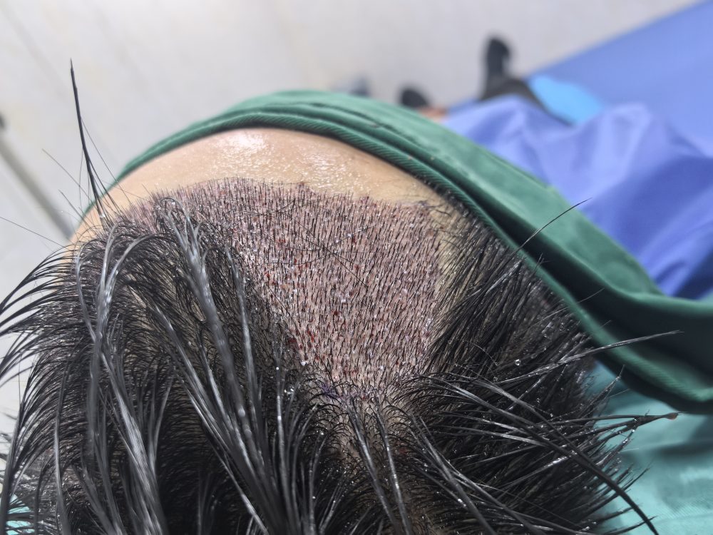 五一小長假植髮好時機？香港髮友必看！術前準備+術後護理全攻略