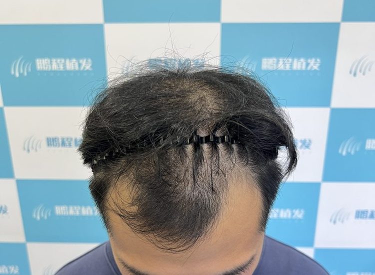 脫髮點解越來越年輕化？香港髮友必知！科學防脫+治療全攻略