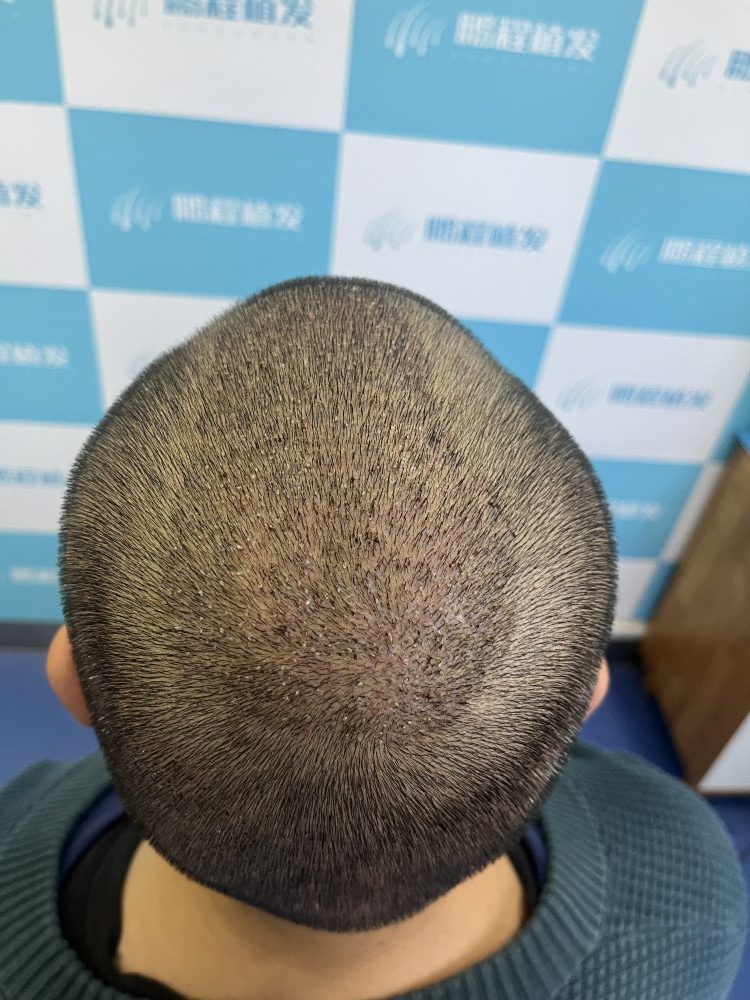 深圳植髮什麼季節最好？選對時機植髮效果真係會翻倍？香港髮友必看