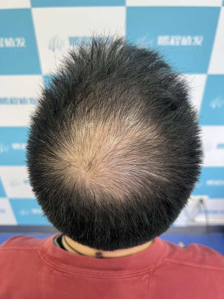 深圳植髮最關心什麼？價格、手術時間、風險一文搞掂！香港髮友必看