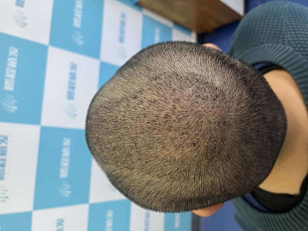 深圳植髮四季選擇指南