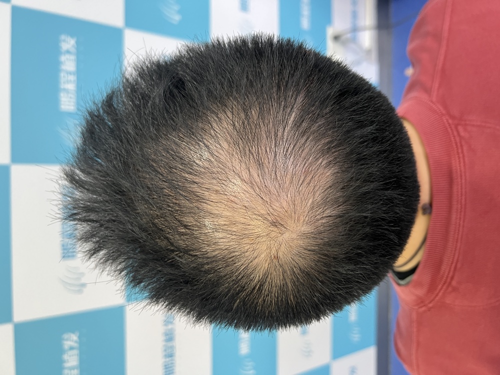 深圳植髮常見疑問解答