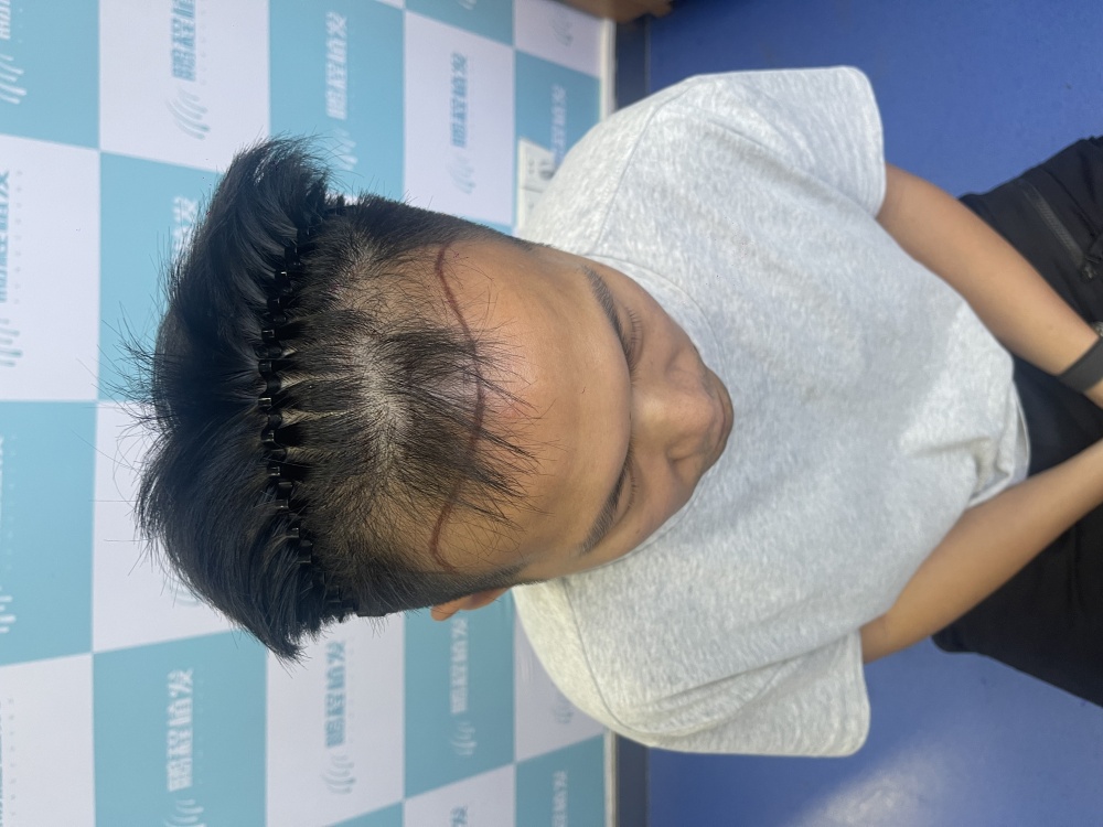 雄激素性脫髮