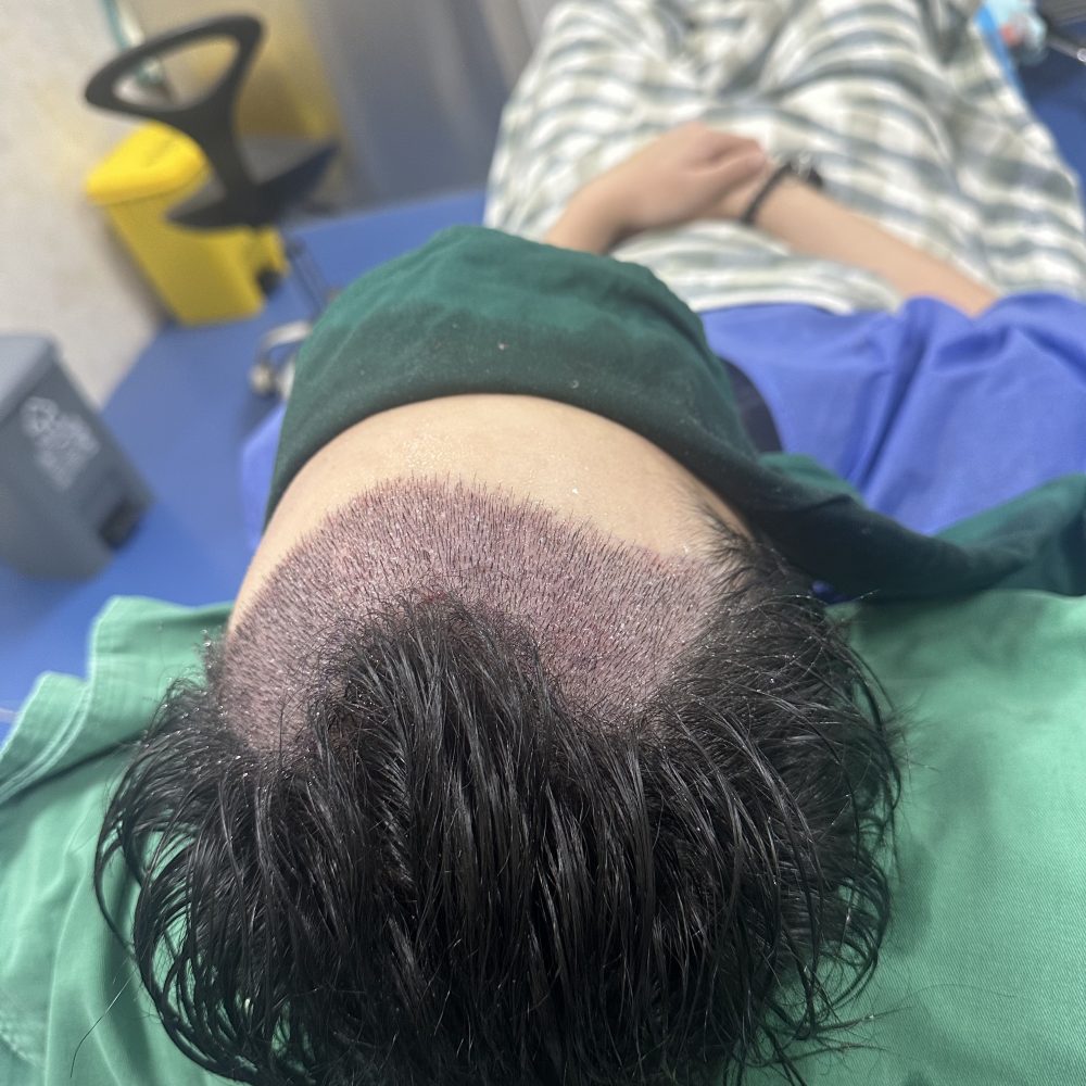 香港植髮避坑指南｜脫髮人士必看，呢啲智商稅千祈唔好交！