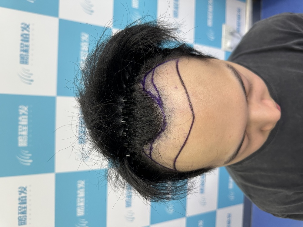 脫髮髮友