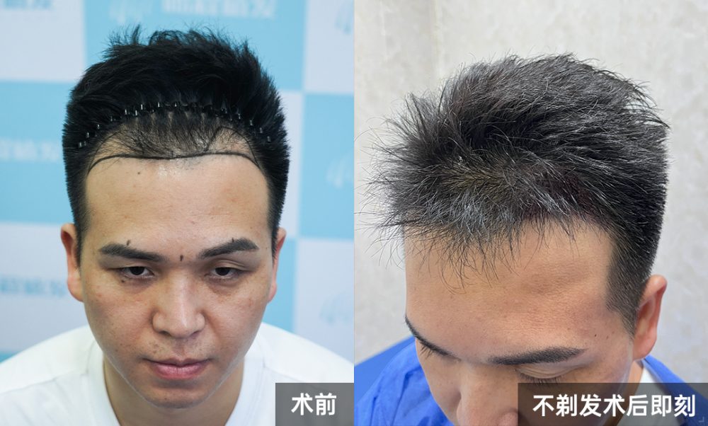 香港男士不剃髮植髮案例｜無剃髮無尴尬，上班社交零影響，重塑自然髮際線