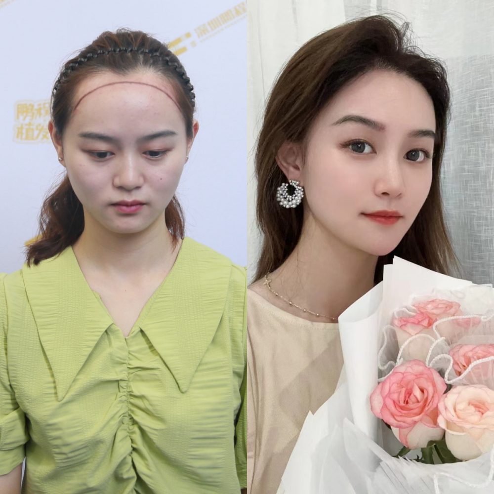 女性髮際線種植真實案例｜高額角救星！種植1年還原原生柔美感，女生必看
