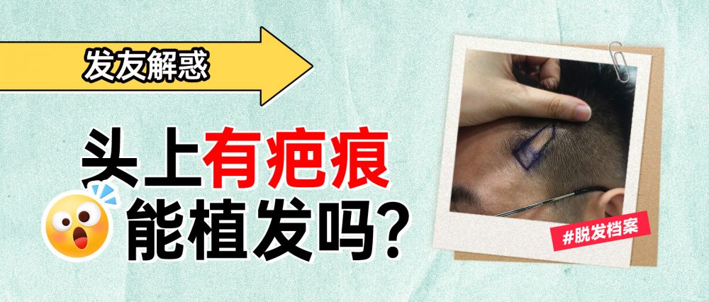頭皮疤痕無髮可以植髮嗎？深圳疤痕植髮條件｜成功率｜效果詳解