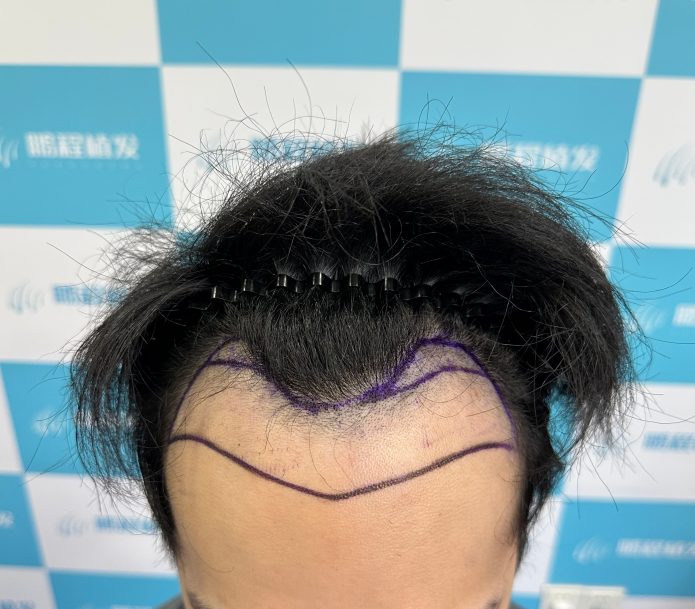 雄激素性脫髮