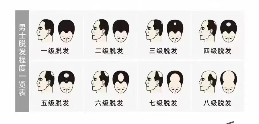 脫髮等級點自测？男女漢密爾頓、路德維希脫髮分級標準完整教學