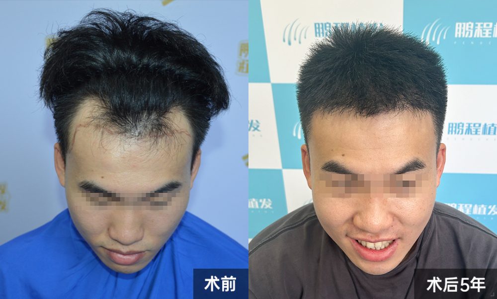 深圳 23 歲林先生植髮案例｜PST 微針救前額 M 禿 術後 5 年少年感滿分