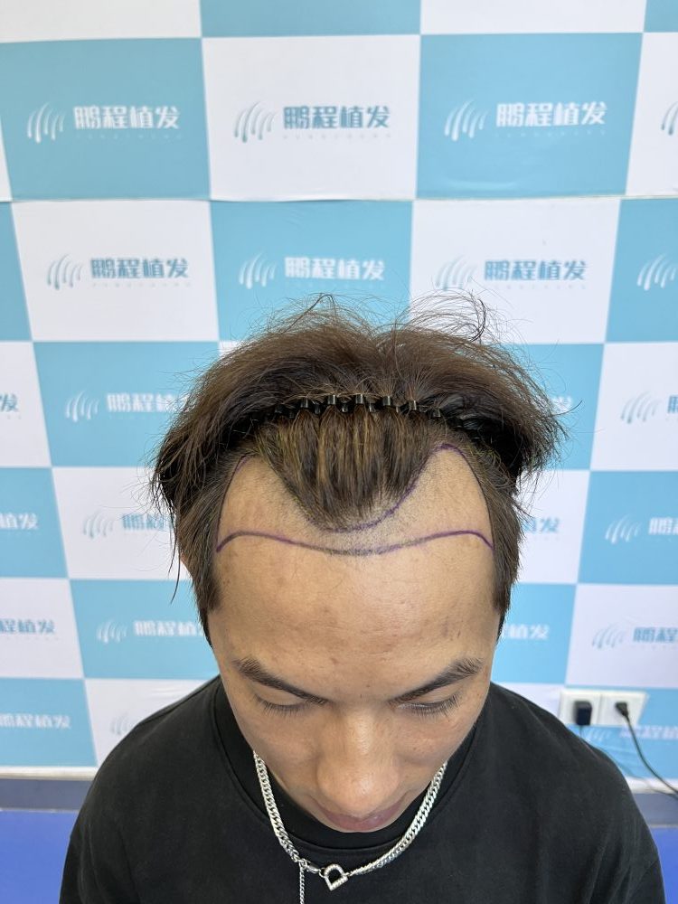 植髮術前設計