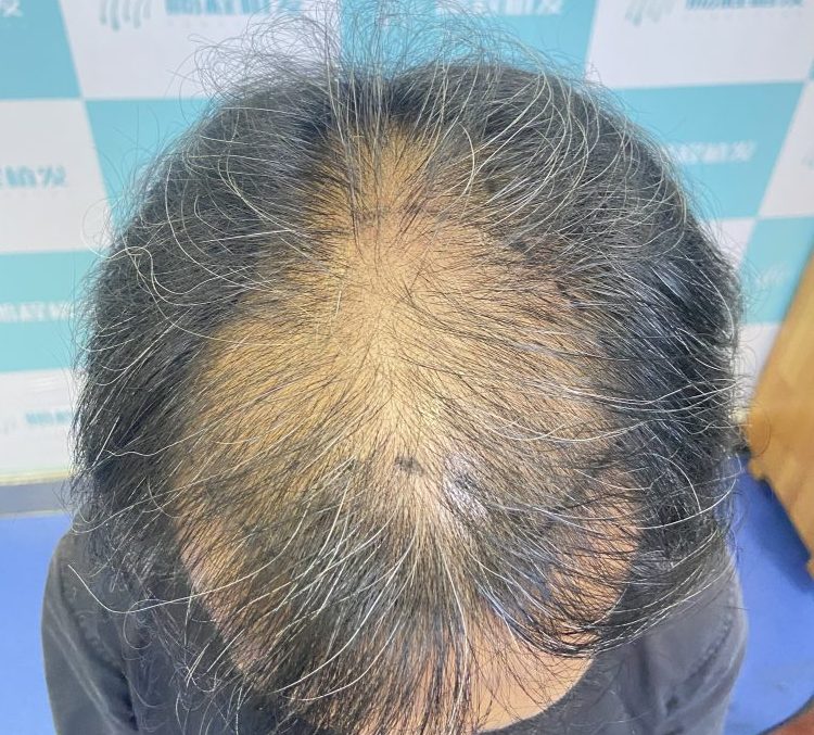 五六十歲植髮有年齡上限嗎？香港長者植髮條件及注意事項 | 深圳鵬程植髮