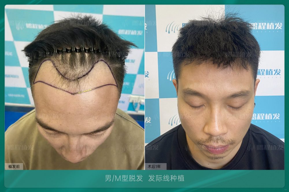 清遠 36 歲許先生植髮案例｜PST 微針救前額 M 禿 術後 1 年少年感滿分