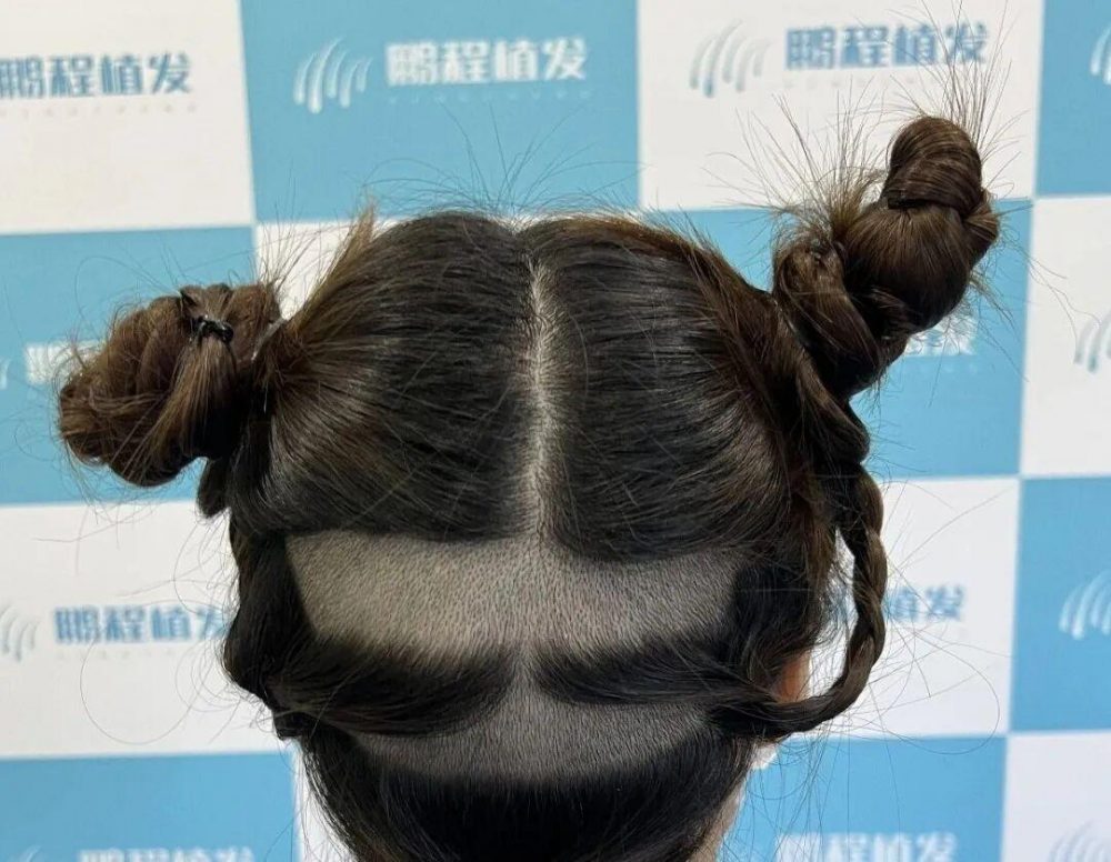 深圳植髮後枕取毛囊會禿頭？拆解後腦稀疏真相與禁忌