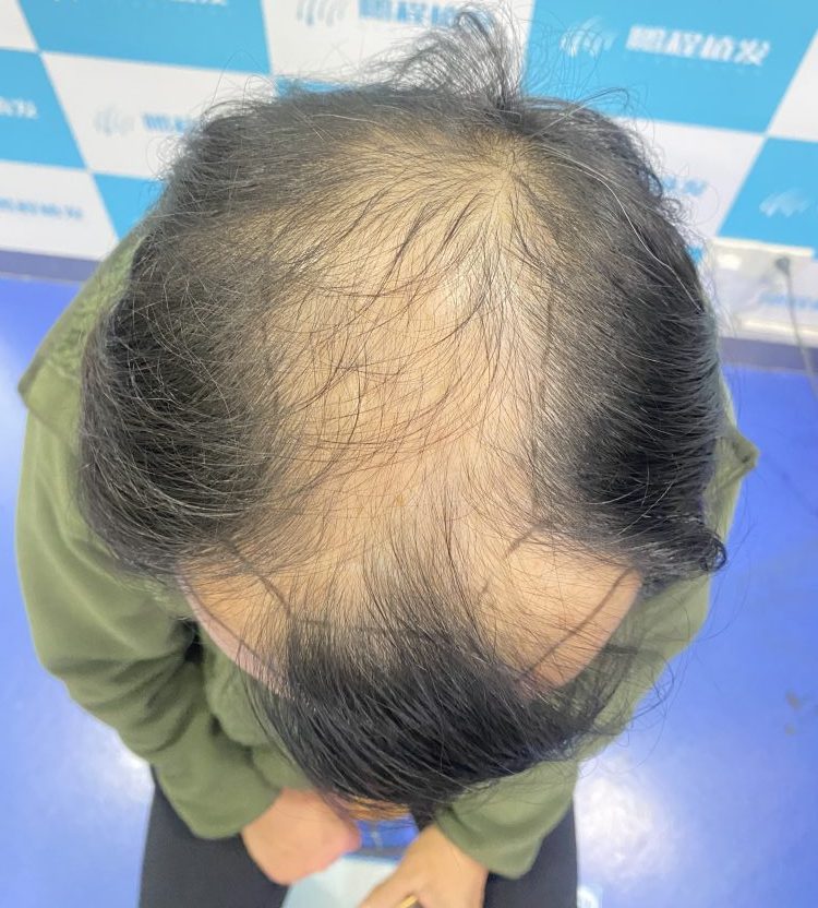 狂脫期可以植髮嗎？香港髪友必看植髮時機避坑指南