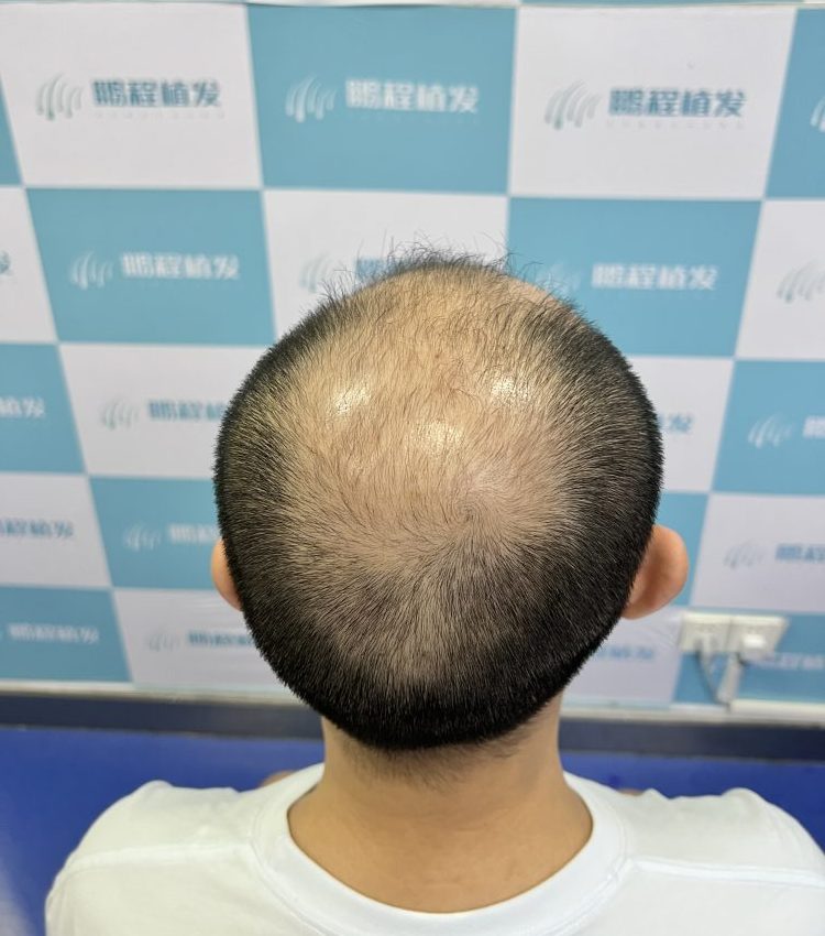 大面积脫髪