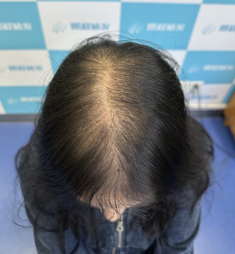 女性脫髪