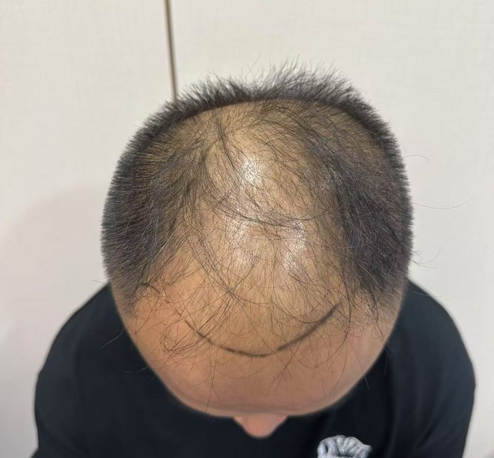 頭頂越嚟越「空」？拆解地中海脫髮成因，香港髪友必睇嘅救髮攻略