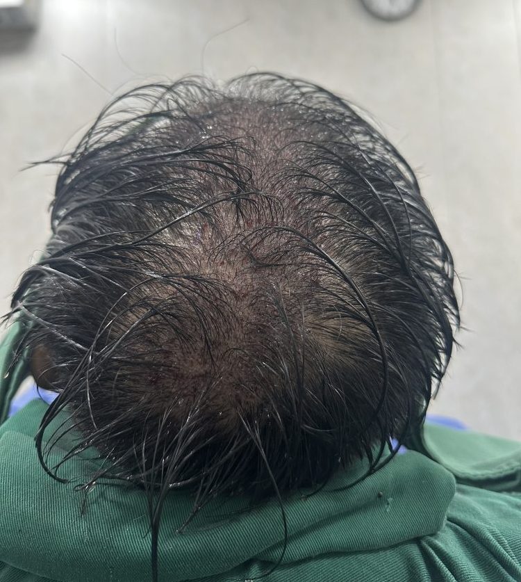植髮前中後全攻略！香港髪友唔使驚，呢份流程清單幫你睇清楚每一步