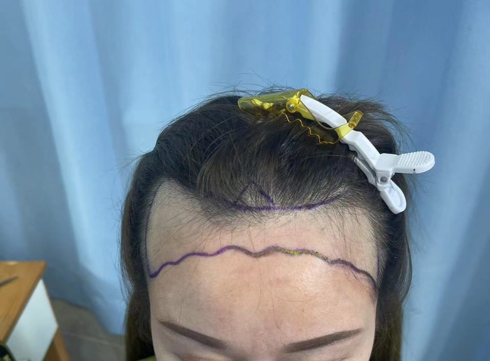 髪際線種植