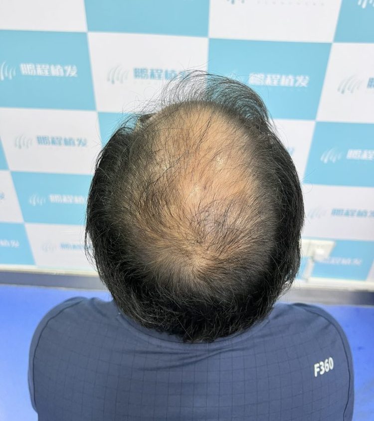 頭頂稀疏