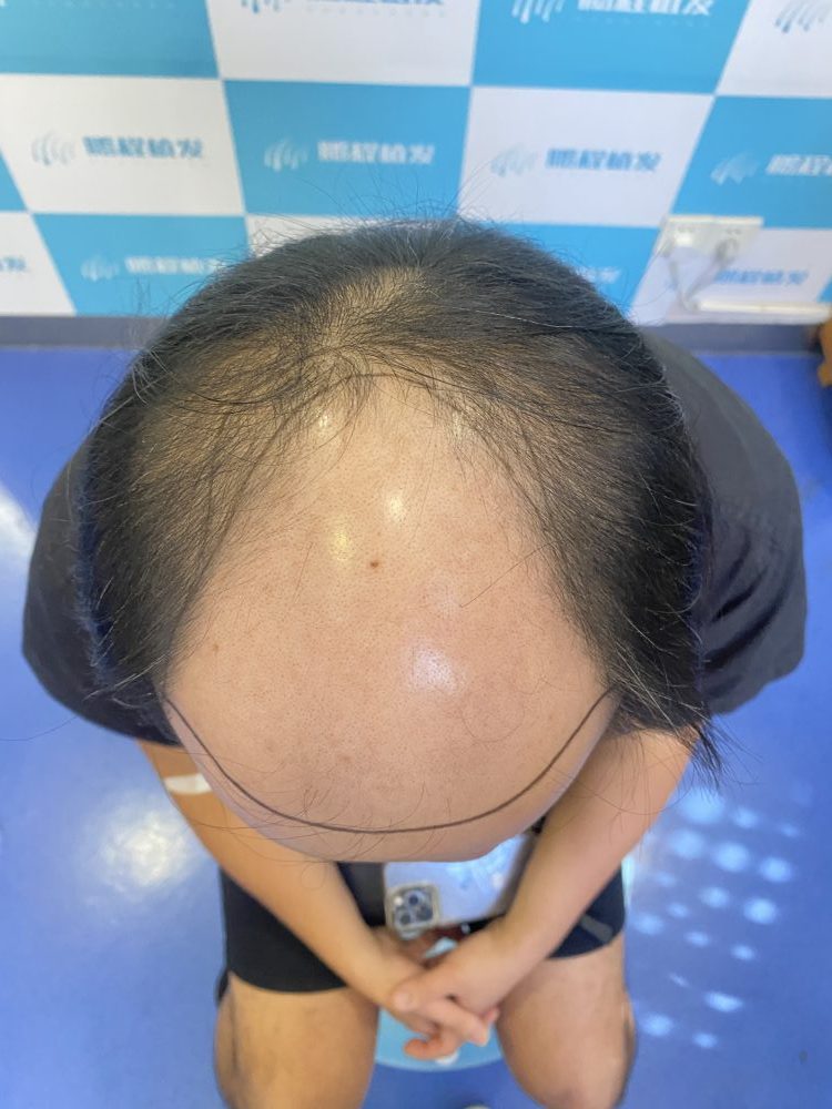 大面積脫髮