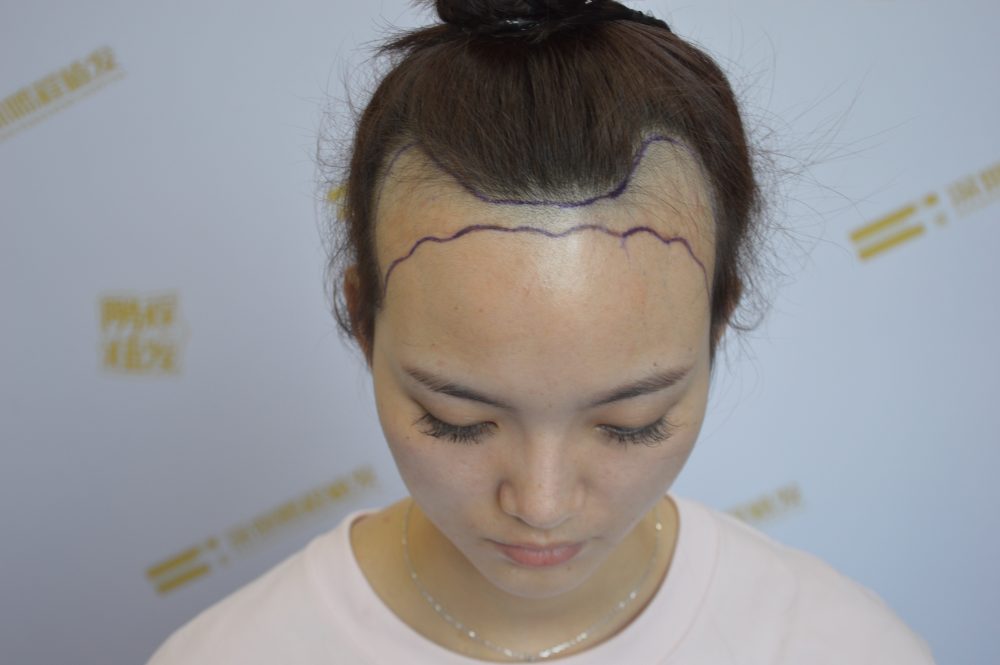 - 女性發際線移植 - 1