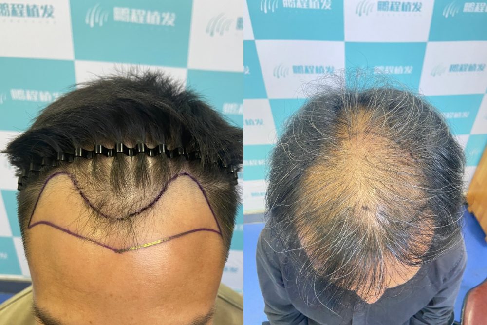 男士M禿+頭頂稀疏