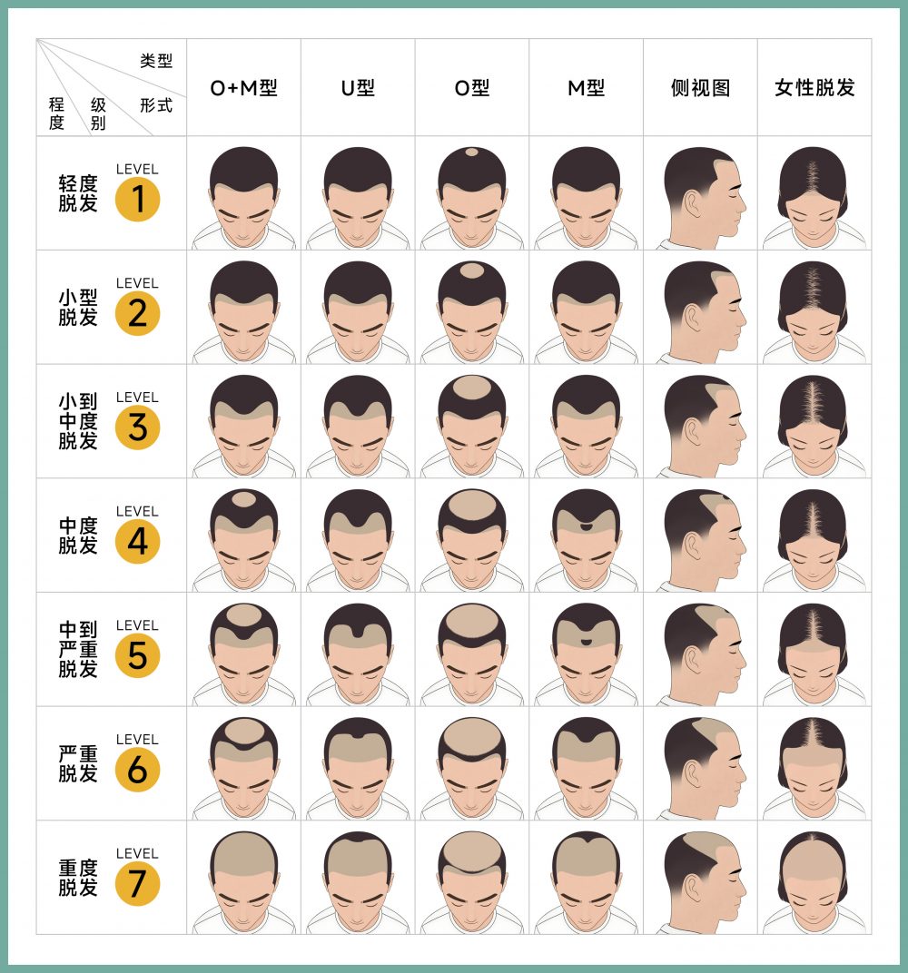 脫髪階段
