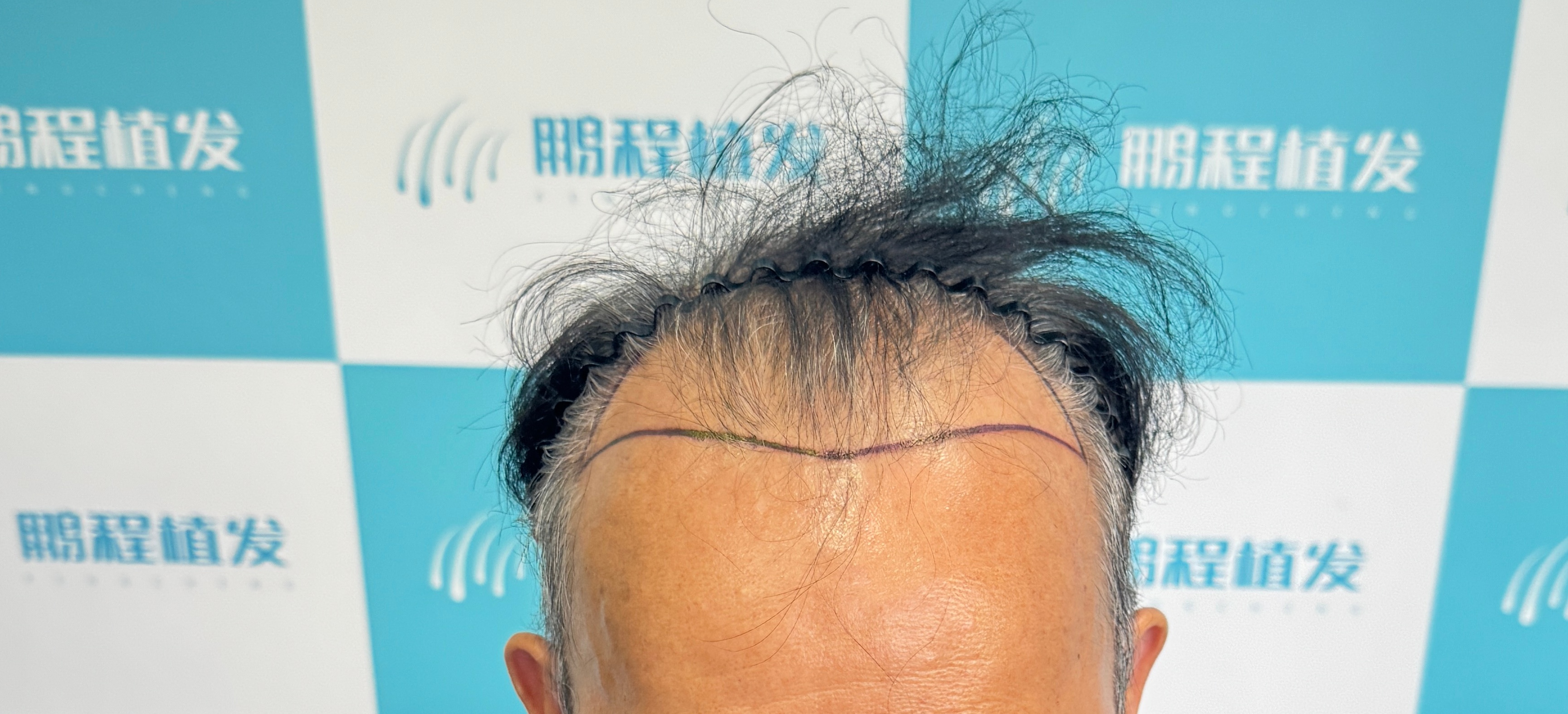 拯救唔完美髮際線形狀 ！深圳鵬程植髮教你揀啱方案自然顯小