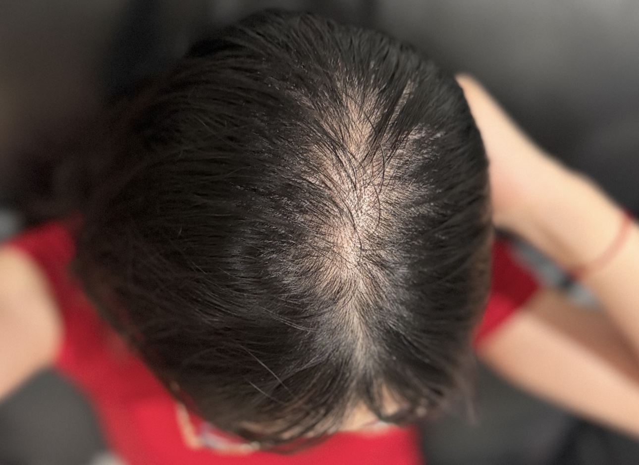 深圳鵬程植髮科普：脂溢性脱髮是什麼原因造成？真的可以治好嗎？
