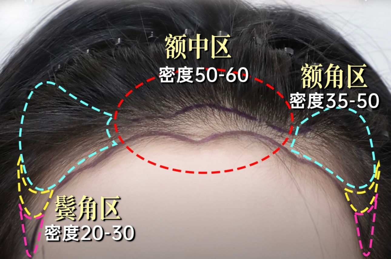 深圳植髮|並非只有脱髮人士先可以做植髮